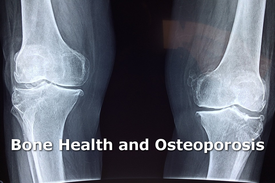 Brashear Family Medical Explains the Importance of Bone Health and Osteoporosis Prevention